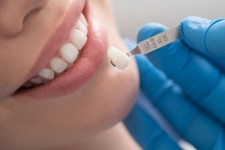 لمینت دندان برای چه افرادی مناسب است؟