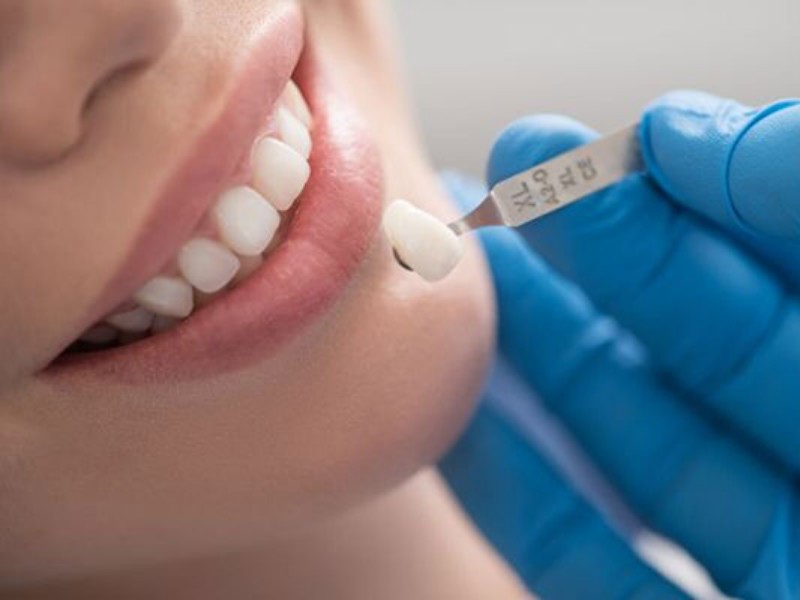 لمینت دندان برای چه افرادی مناسب است؟ لمینت دندان برای چه افرادی مناسب است؟