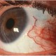 اقدامات اولیه و اورژانسی آسیب‌های چشمی